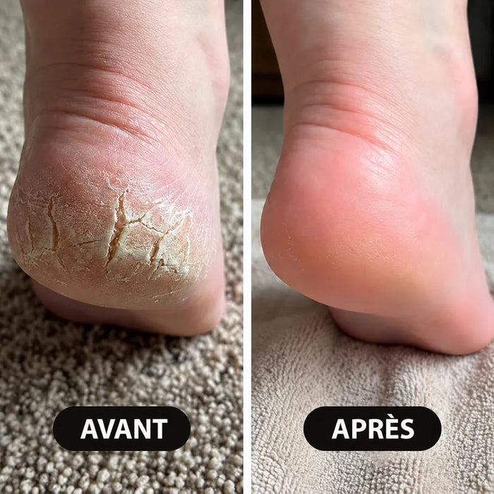 Talons de Sophie L. avant et après le stick