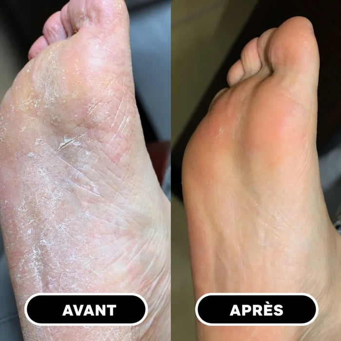 Talons de Philippe R. avant et après le stick