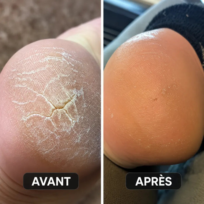 Talons de Martine D. avant et après le stick