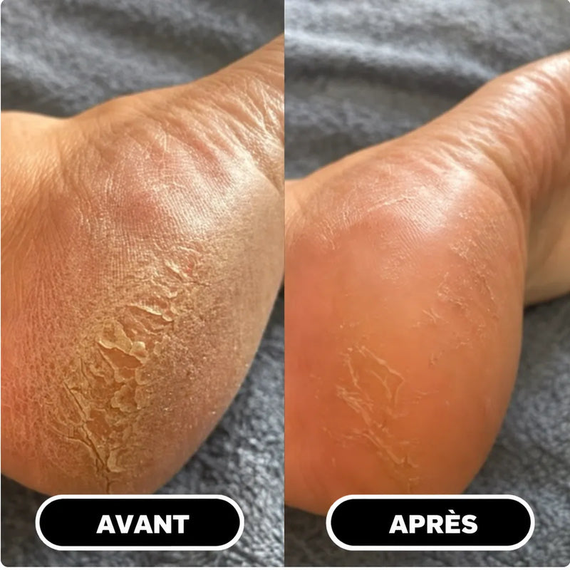 Stick anti-crevasses pour talons, visuel 5
